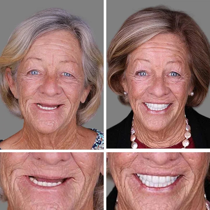 Medical Full Denture with Strong Suctiond🦷