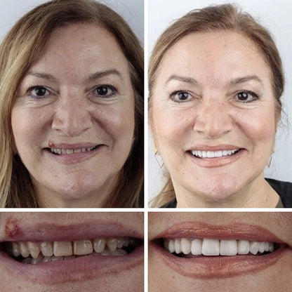 Medical Full Denture with Strong Suctiond🦷