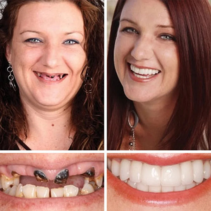 🔥Ends Today: 75% OFF! ⏰DarkFairy™ Medical Full Denture with Strong Suctiond Custom-Fit Full Functional Dentures🦷