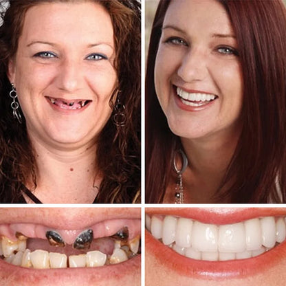 🔥Ends Today: 75% OFF! ⏰DarkFairy™ Medical Full Denture with Strong Suctiond Custom-Fit Full Functional Dentures🦷